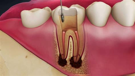 Check spelling or type a new query. What Is a Root Canal and When Would I Need One? - Toronto ...