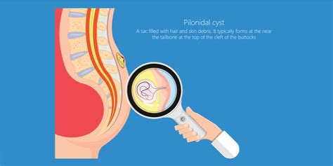 Living With Pilonidal Sinus Things To Take Care Of Pristyn Care