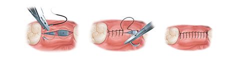 Dental Suture Techniques And Materials In Oral Surgery Boz Medical