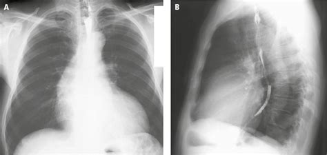 Figure 0310852 Posteroanterior Pa A And Lateral B Chest