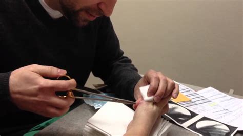 Doctor Pulls Pins From Broken Hand Youtube