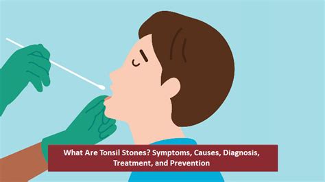 What Are Tonsil Stones Symptoms Causes Diagnosis Treatment And