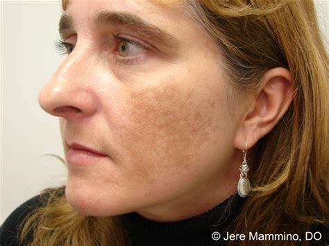 Melasma American Osteopathic College Of Dermatology Aocd