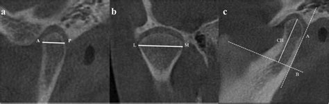 Parasagittal A Coronal B And Sagittal C Cbct Reconstructions