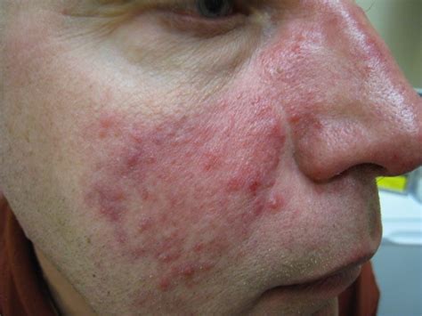 Well Being Acne And Rosacea Society Of Canada