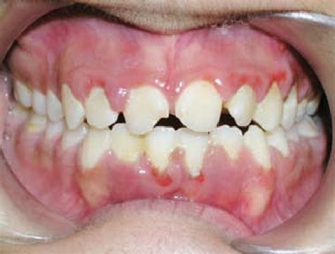 Healing Of Gingival Hyperplasia At The Eight Week Of Chemotherapy No