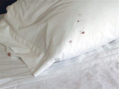 Key Signs And Symptoms Of Bed Bugs Orkin Canada