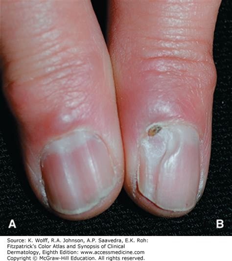 Icd 10 Code For Mucous Cyst Left Middle Finger