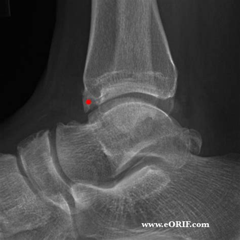 Anterior Ankle Impingement Images Eorif
