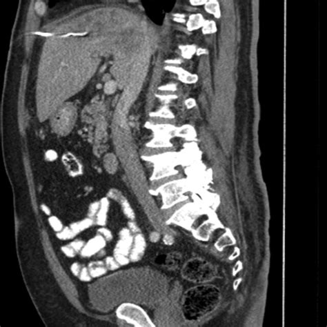 Abdominal And Pelvis Computed Tomography With Oral And Intravenous