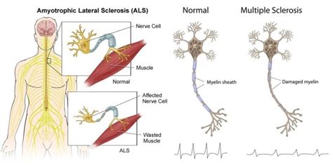 The Difference Between Als And Ms Ireland Multiple Sclerosis And Me