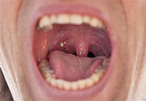 Tonsil Stones Might Be Causing Your Bad Breath Health Essentials From