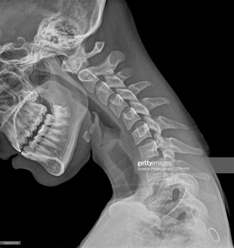 Stock Photo Normal Flexed Neck X Ray Anatomy Art Human Anatomy