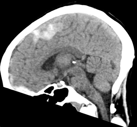 Acute Tonsillar Cerebellar Herniation In A Patient With Traumatic Dural