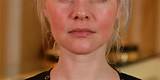 Images of Makeup For Rosacea Skin