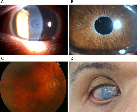 Glaucoma is the second leading cause of blindness. Images of eyes of a patient with pseudoexfoliation ...