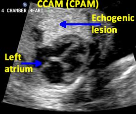 Patient preparation and position for the ultrasound examination 4. 13.CPAM | OB Images