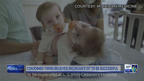 ‘power Of Positive Michigan Conjoined Twins Separated Wlns 6 News