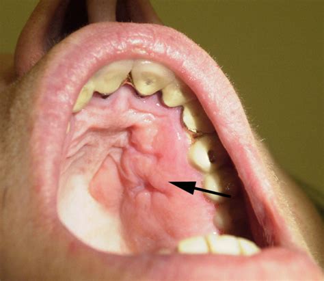 Clinical Photograph Of The Hard Palate Lesion After Biopsy Download