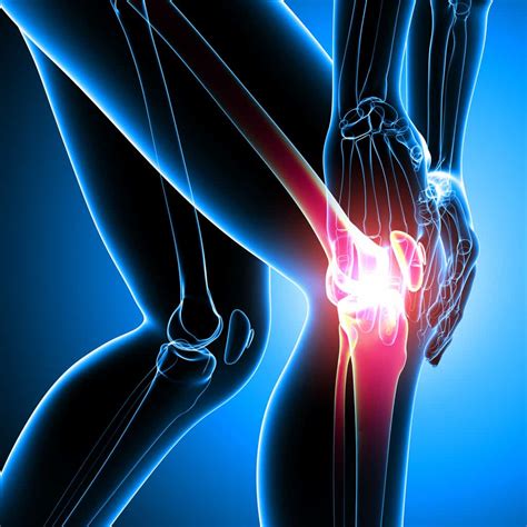 Treating The Arthritic Knee Current Concepts In Rehabilitation Of Patellofemoral Pain And