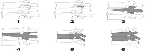 The Comprehensive Anatomical Spinal Osteotomy Classification Neurosurgery