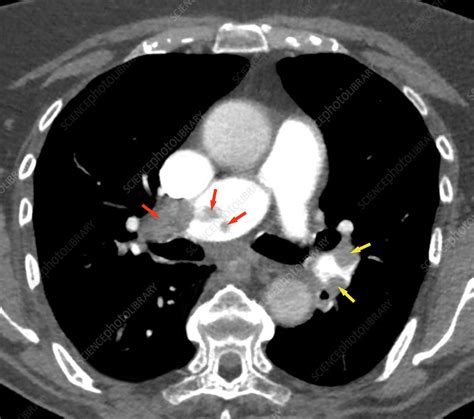 Acute Pulmonary Embolism Ct Scan Stock Image C029 4561 Science Photo Library