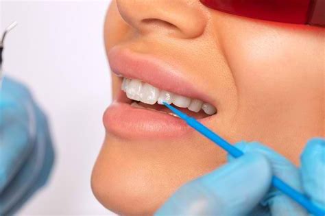 Penyebab Munculnya Noda Pada Gigi Dan Cara Mengatasinya Alodokter