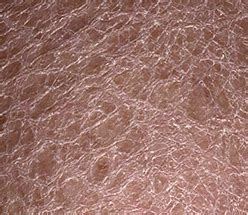 Alleviate Scaly Patches West Valley Dermatology