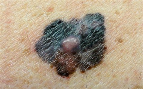 Spot The Difference Between A Simple Mole Or More Serious Melanoma