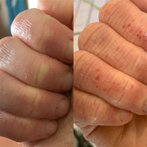 Healing Bad Hand Eczema What Allergy Blog