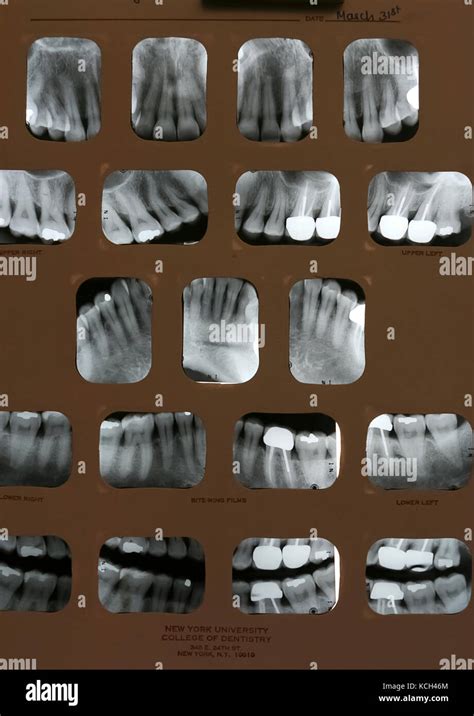 Dental X Rays Full Mouth Films Show Receding Gums And Numerous Past