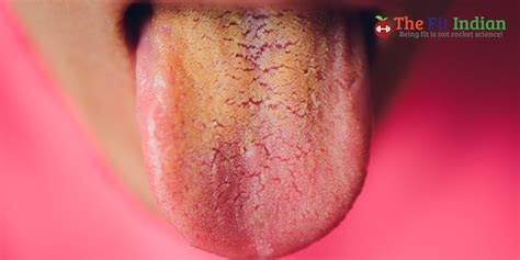 Dangers of Tongue Discoloration - Diseases Associated with Tongue Color ...