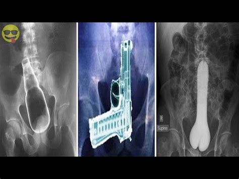 25 Most Strangest Things Found Stuck In A Rectum YouTube