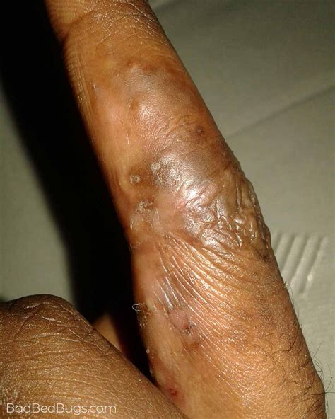 What Do Bed Bug Bites Look Like On A Black Person See More On Home