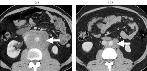 Retroperitoneal Lymphadenopathy Contrast Enhanced Ct A Before And