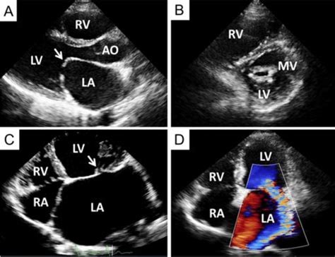 Transthoracic Echocardiography From A Patient With Severe Mitral