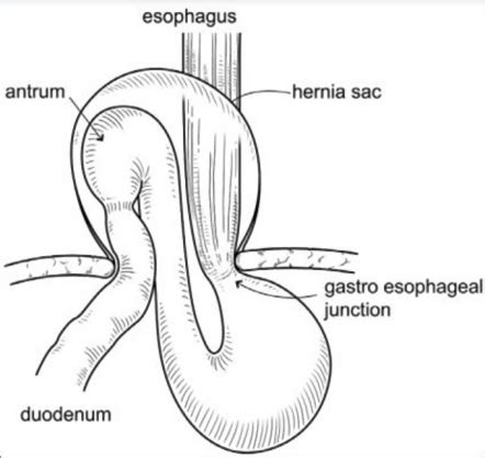 Paraesophageal Hernia Radiology Reference Article Radiopaedia Org