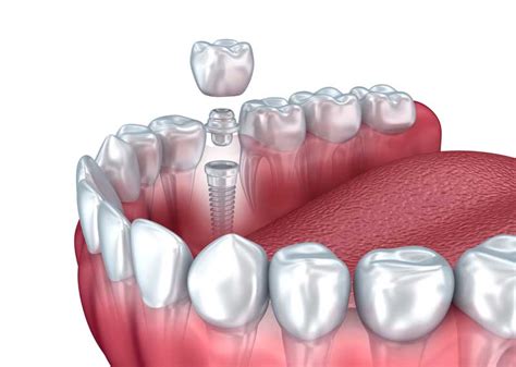 Mini Dental Implant Spring Hill Smiles Dental Office Spring Hill Tn