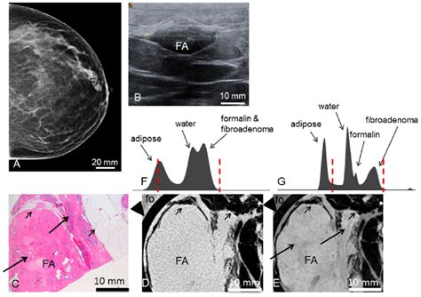 Preoperative Imaging Histology Absorption And Phase Contrast Ct Of
