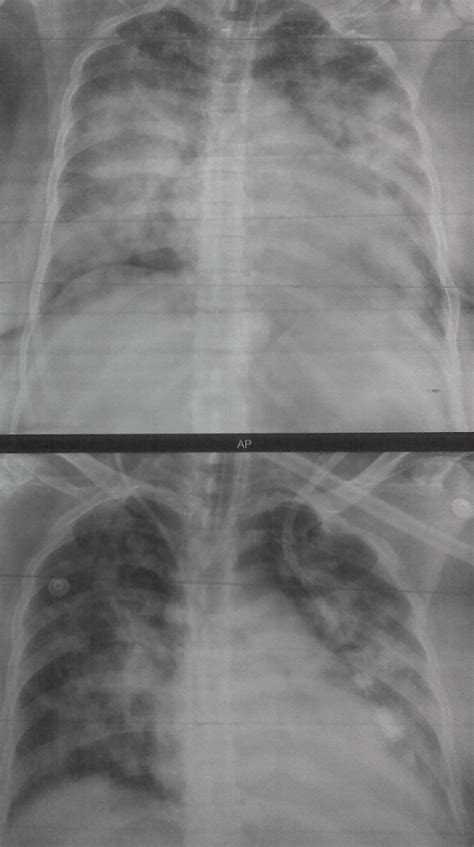 Pulmonary Edema Cxr Sumers Radiology Blog