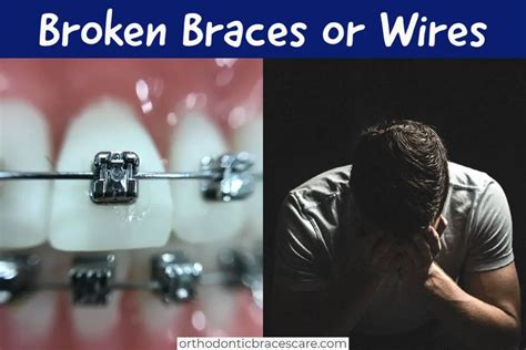 What Happens When Your Braces Wire Breaks Orthodontic Braces Care