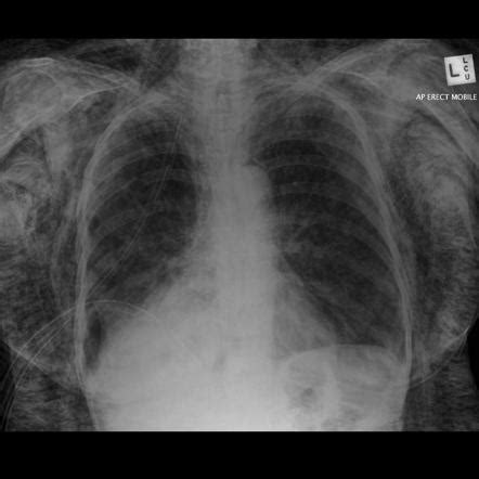 Subcutaneous Emphysema Chest X Ray Sexiz Pix