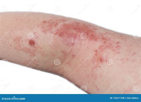 Eczema On The Elbow Stock Photo Image Of Itchy Condition 176271708