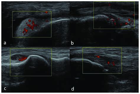 A Transverse Scan Through The Lateral Part Of The Suprapatellar
