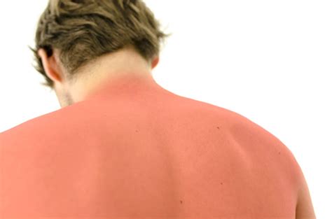 Can You Get Rid Of Sunburn Fast What To Do To Help Ease Red Itchy