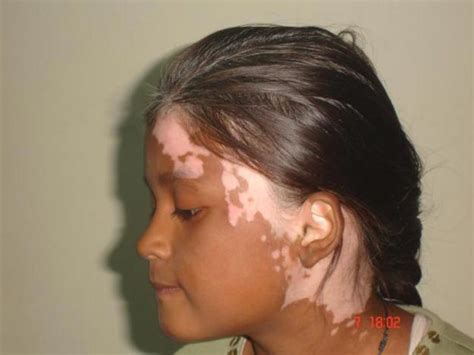 Vitiligo An Incurable Skin Disorder That May Be Helped Naturally