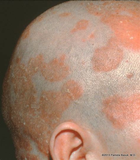 Seborrheic Dermatitis Dandruff Basuk Dermatology