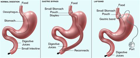What Is Bariatric Surgery Courtney Medical Group