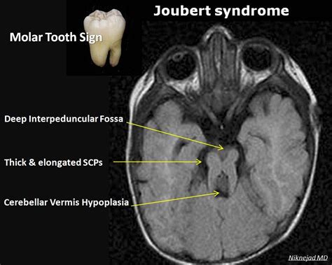 Molar Tooth Sign Radrounds Radiology Network