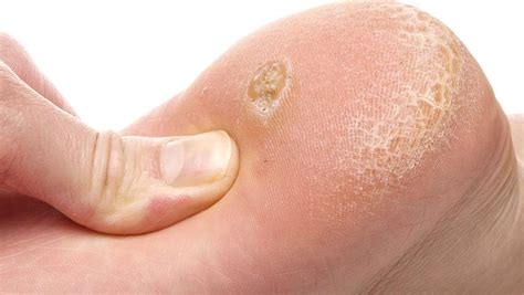 5 Cheap Natural Products Dermatologists Swear By For Callus Removal